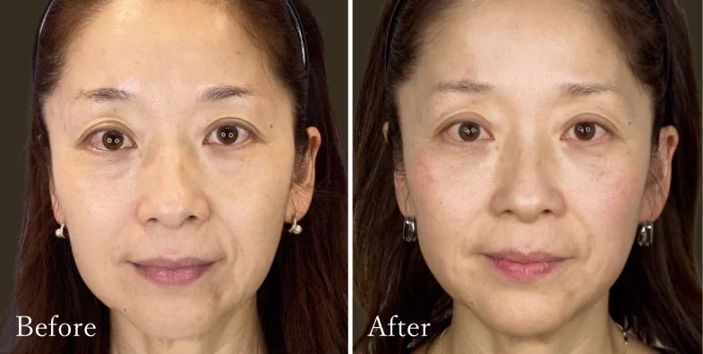 症例1 Before/After