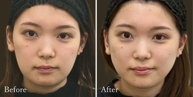 症例3 Before/After