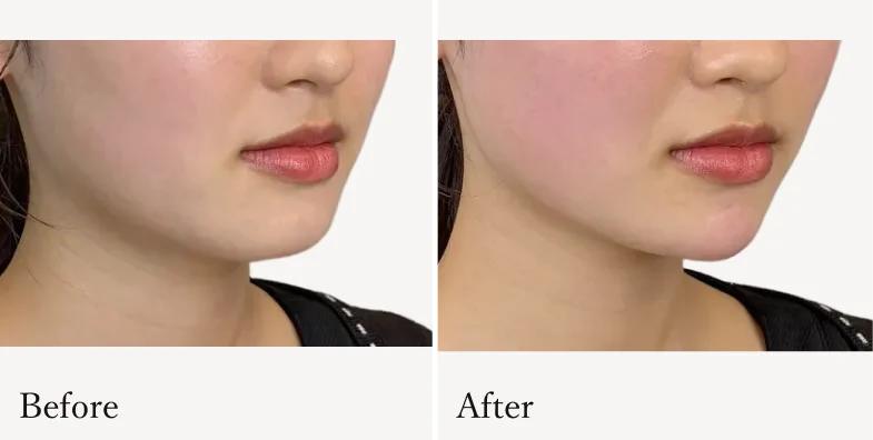 症例2 Before/After