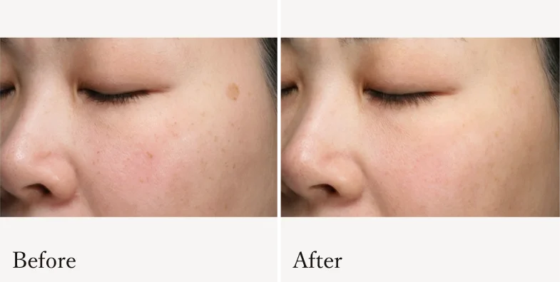 症例3 Before/After