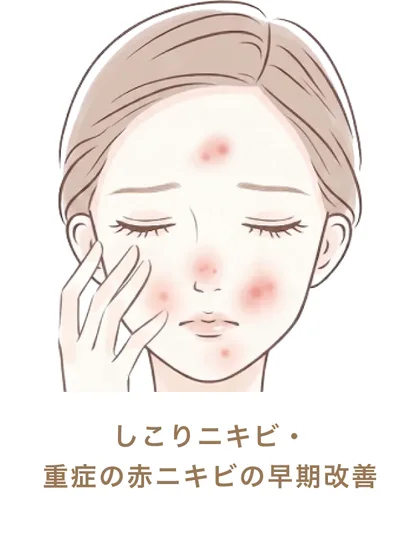 しこりニキビ・重症の赤ニキビの早期改善