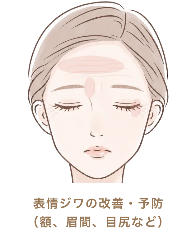 表情ジワの改善・予防（額、眉間、目尻など）