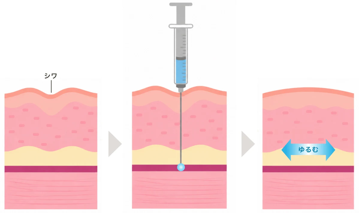 シワのある皮膚に薬剤を注射し、筋肉がゆるんでシワが改善するまでの3段階の図