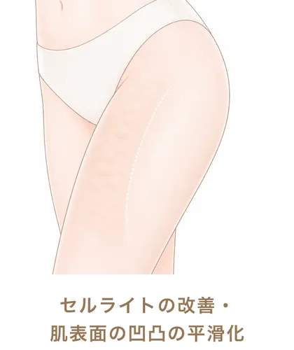 セルライトの改善・肌表面の凹凸の平滑化
