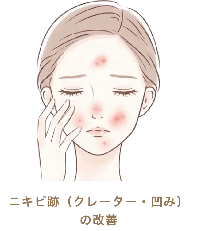 ニキビ跡（クレーター・凹み）の改善