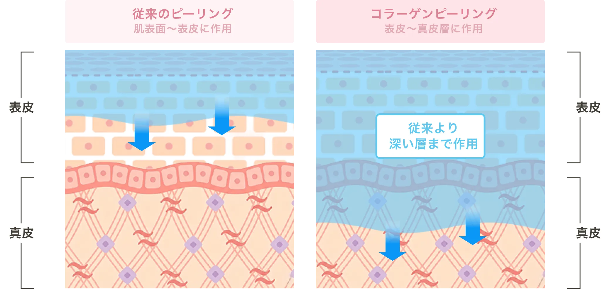 従来のピーリングとコラーゲンピーリングの作用層の比較図