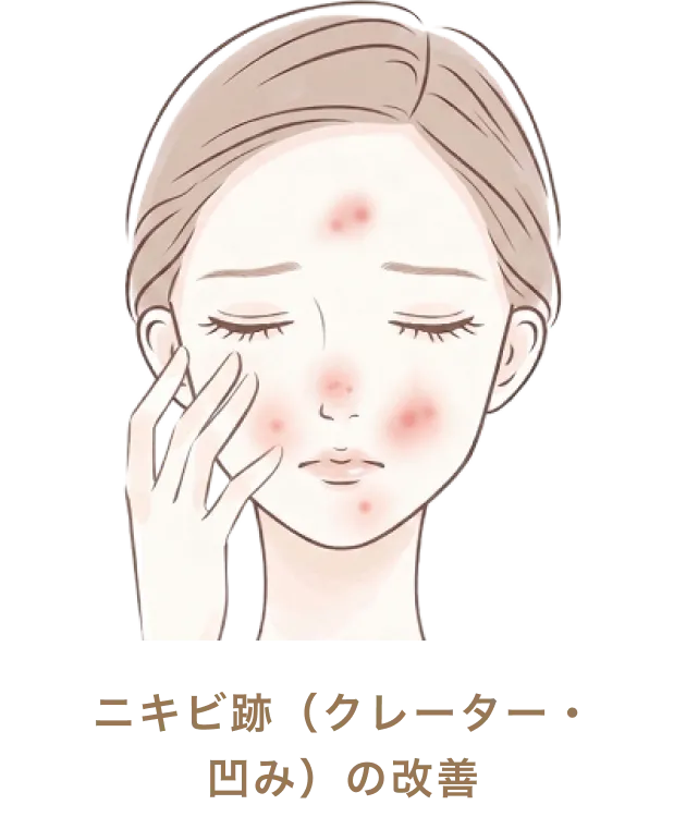 ニキビ跡（クレーター・凹み）の改善