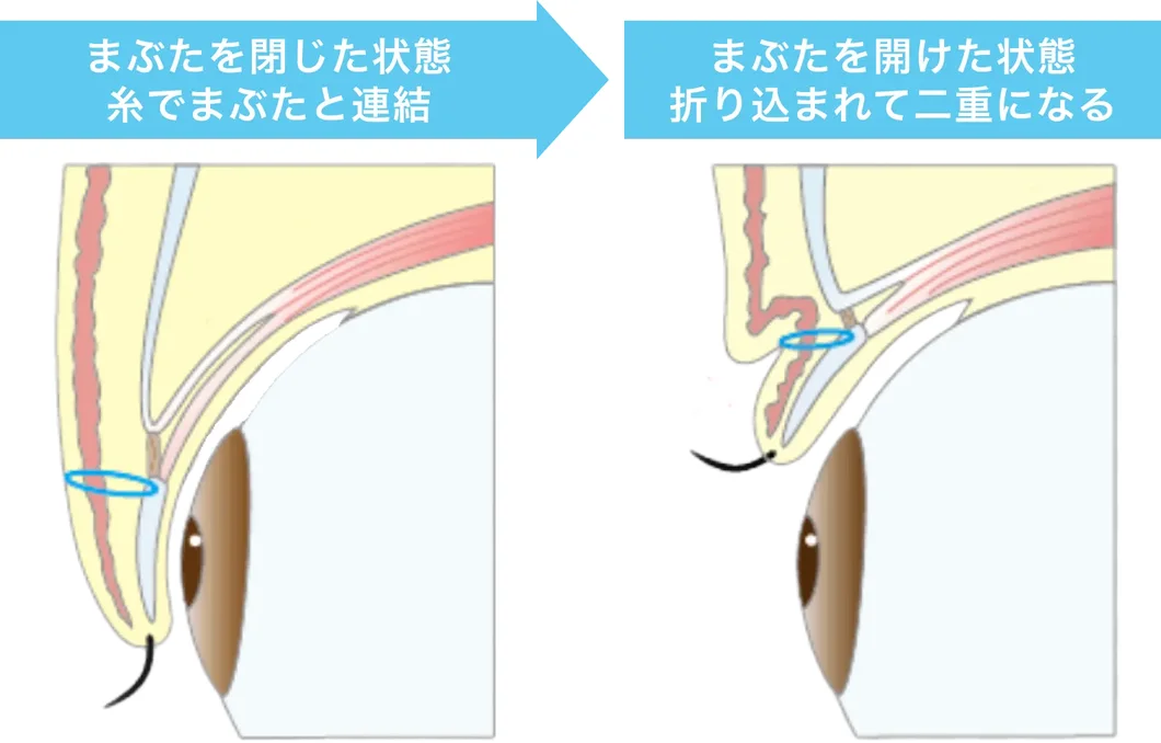 まぶたを閉じた状態：糸でまぶたと連結／まぶたを開けた状態：折り込まれて二重になる