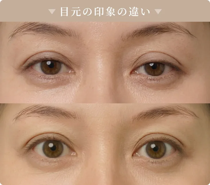 目元の印象の違い。二重のラインや目の開きが異なる2例の目もとの比較