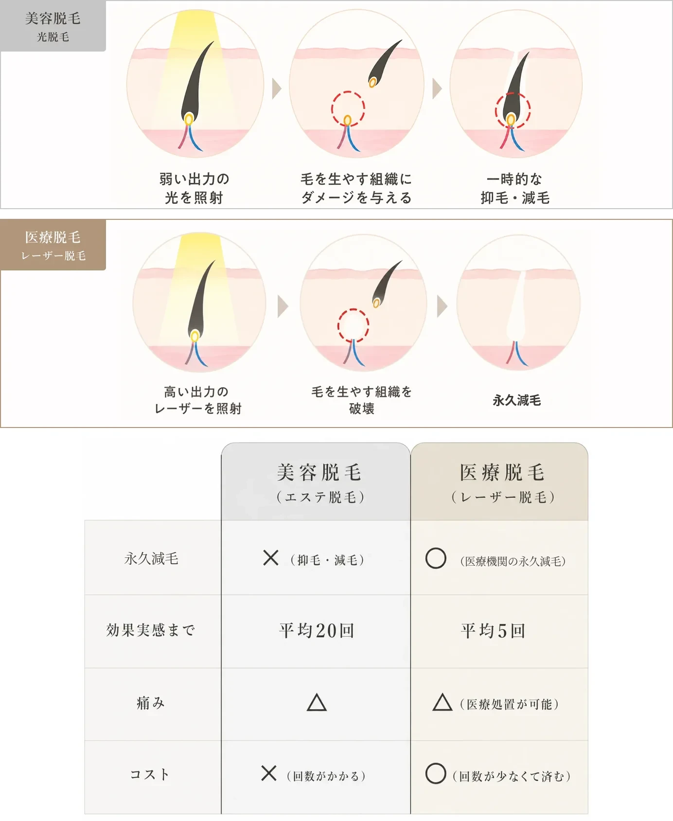 美容脱毛（光脱毛）は弱い出力の光で毛を生やす組織にダメージを与え一時的な抑毛・減毛にとどまるのに対し、医療脱毛（レーザー脱毛）は高い出力のレーザーで毛を生やす組織を破壊し半永久脱毛を目指す。永久脱毛・効果実感まで（美容脱毛は平均20回、医療脱毛は平均5回）・痛み・コストを比較した表