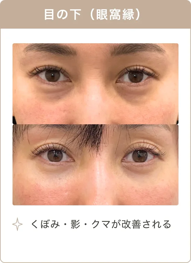 目の下（眼窩縁）：くぼみ・影・クマが改善される