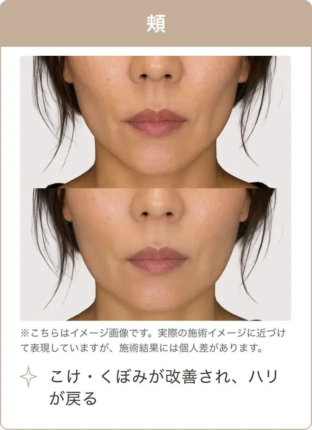 頬：こけ・くぼみが改善され、ハリが戻る（※こちらはイメージ画像です。実際の施術イメージに近づけて表現していますが、施術結果には個人差があります。）