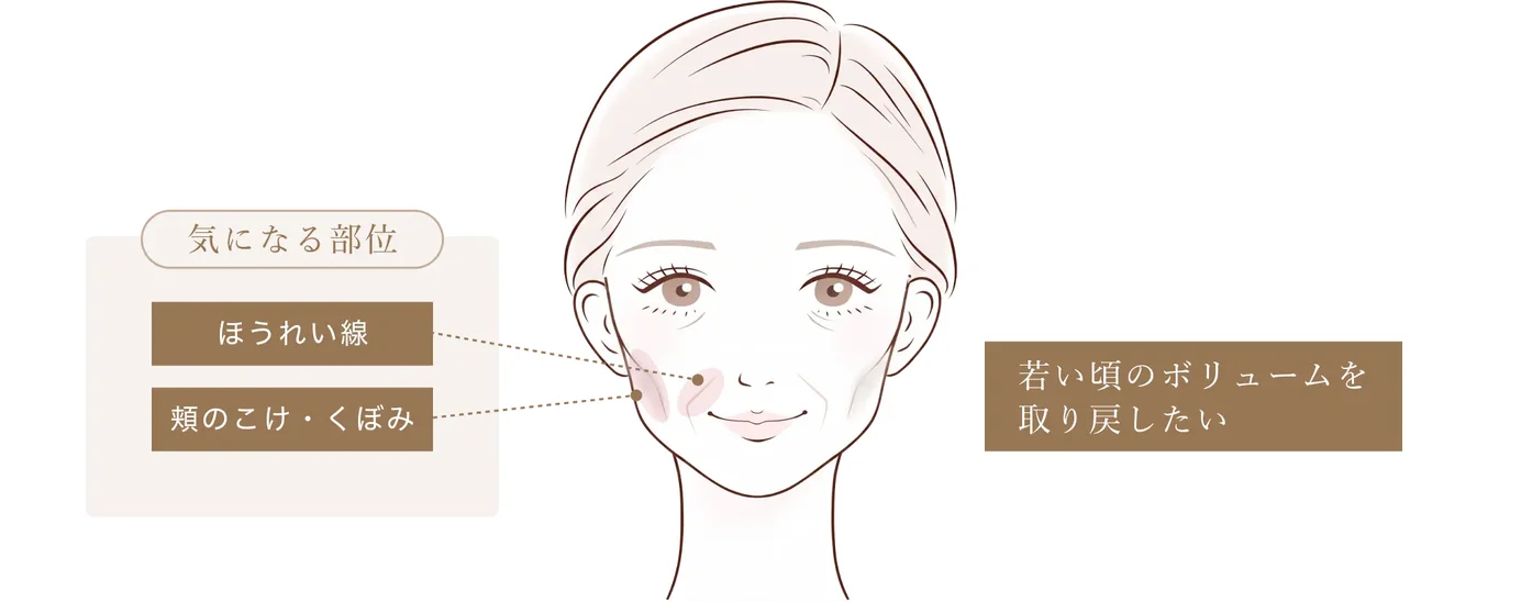 気になる部位はほうれい線・頬のこけ・くぼみ。「若い頃のボリュームを取り戻したい」という目的を示した図