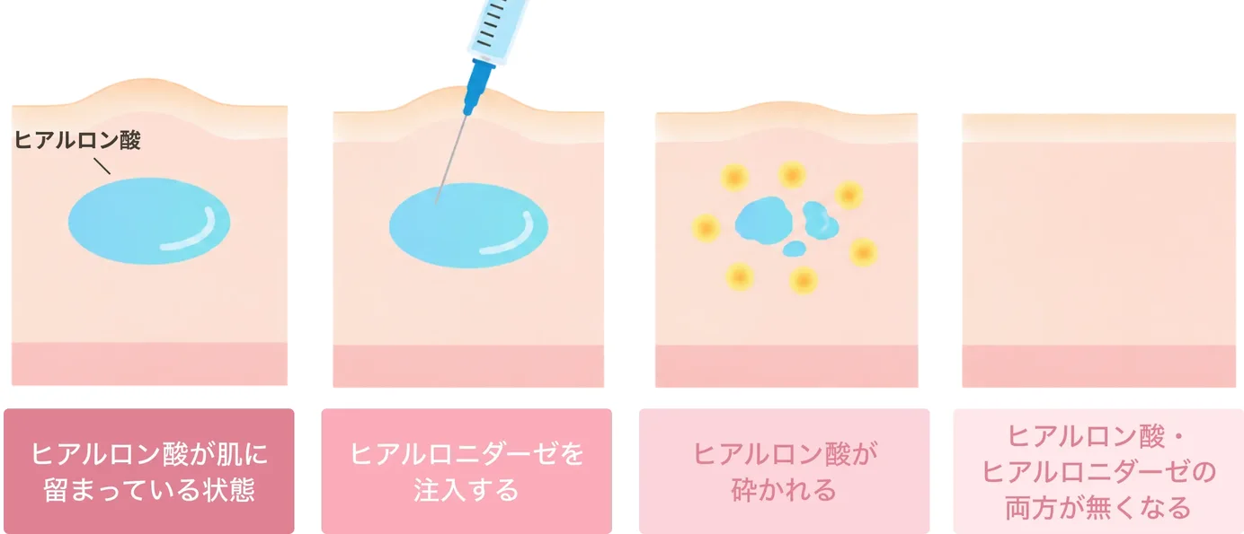 ヒアルロン酸が肌に留まっている状態、ヒアルロニダーゼを注入する、ヒアルロン酸が砕かれる、ヒアルロン酸・ヒアルロニダーゼの両方が無くなる、の4段階の図