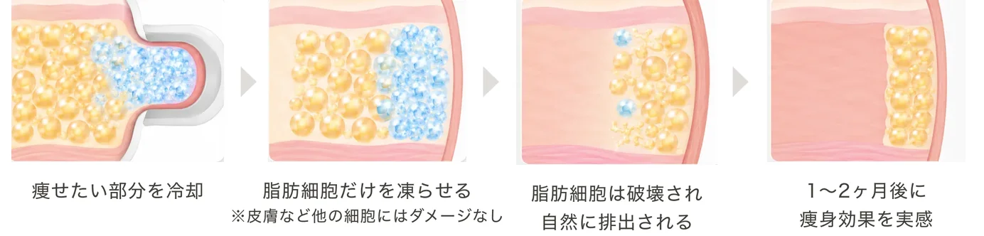 脂肪冷却の仕組み。痩せたい部分を冷却し、脂肪細胞だけを凍らせ（皮膚など他の細胞にはダメージなし）、脂肪細胞は破壊され自然に排出され、1〜2ヶ月後に痩身効果を実感するまでの4段階の図