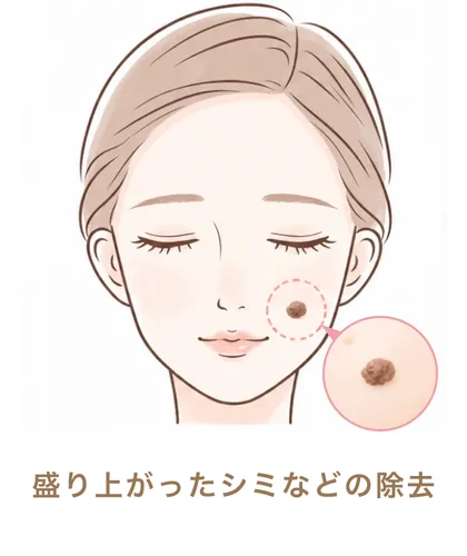 盛り上がったシミなどの除去