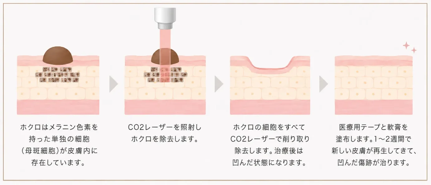 CO2レーザーでほくろの組織だけを蒸散させて除去する仕組みの図