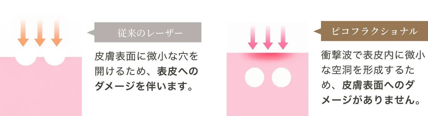 従来のレーザーは皮膚表面に微小な穴を開けるため表皮へのダメージを伴うのに対し、ピコフラクショナルは衝撃波で表皮内に微小な空洞を形成するため皮膚表面へのダメージがないことを示す比較図