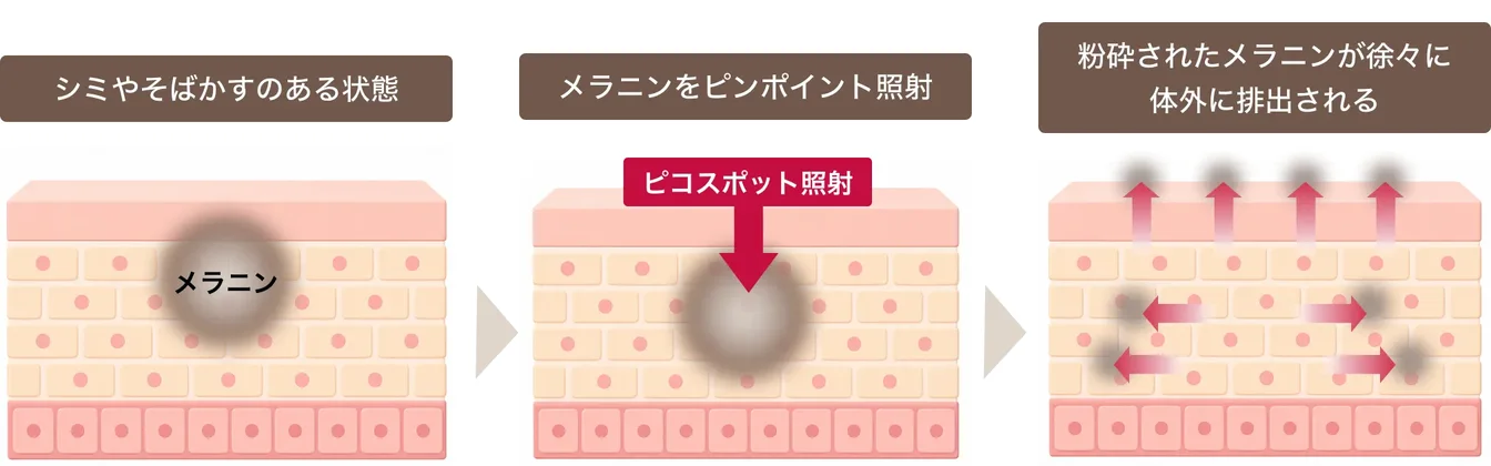 シミやそばかすのある状態、メラニンをピンポイント照射、粉砕されたメラニンが徐々に体外に排出される、の3段階の図