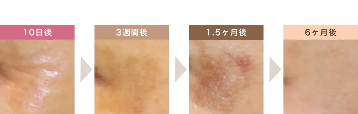 照射後10日後・3週間後・1.5ヶ月後・6ヶ月後の肌の変化。3週間後から1.5ヶ月後にかけて色が濃くなり、6ヶ月後には消失している