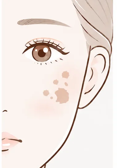 老人性色素斑のイメージ。頬に茶色のまとまった色素がある顔のイラスト