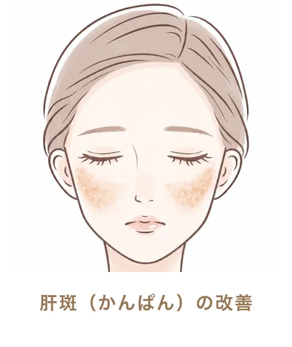 肝斑（かんぱん）の改善