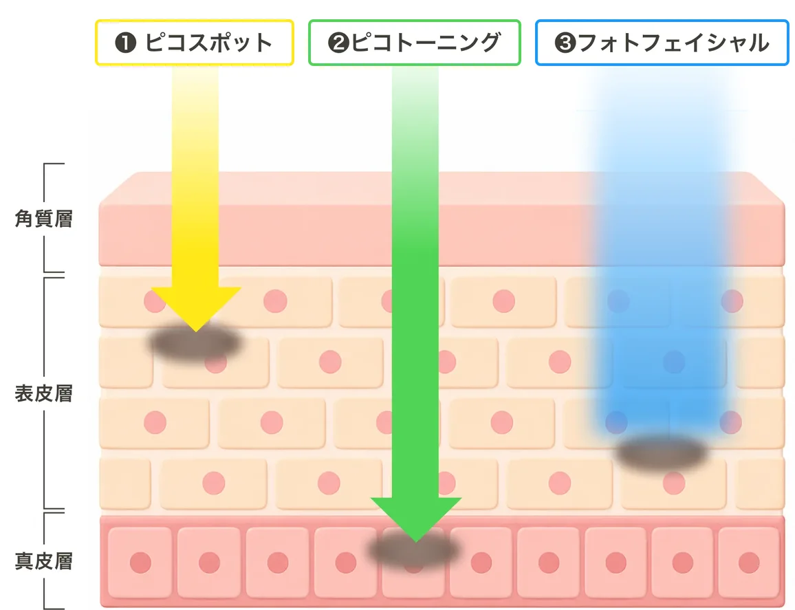 ピコスポット・ピコトーニング・フォトフェイシャルがそれぞれ角質層・表皮層・真皮層のどこまで届くかを矢印で示した図