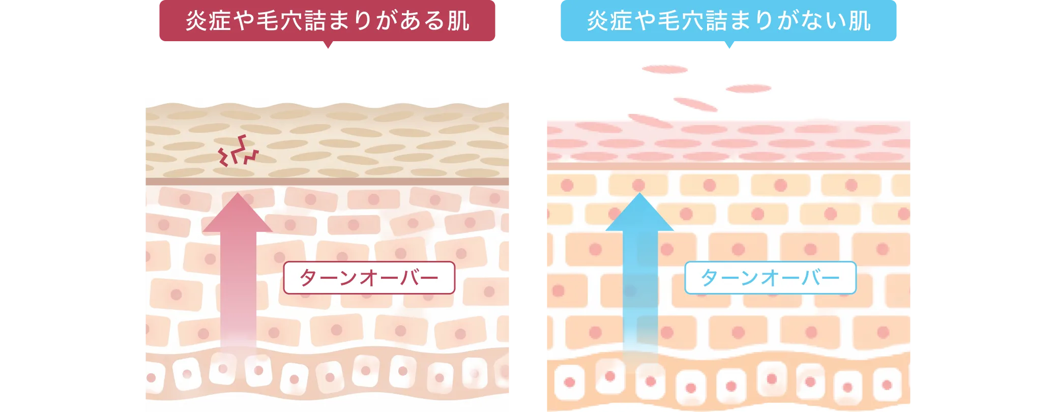 炎症や毛穴詰まりがある肌とない肌のターンオーバー比較図
