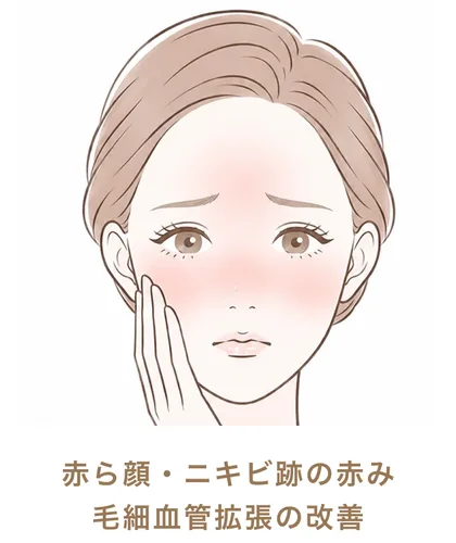 赤ら顔・ニキビ跡の赤み毛細血管拡張の改善