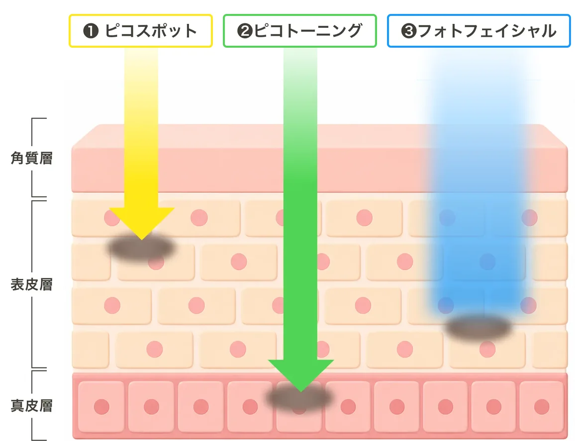 ピコスポット・ピコトーニング・フォトフェイシャルがそれぞれ角質層・表皮層・真皮層のどこまで届くかを矢印で示した図