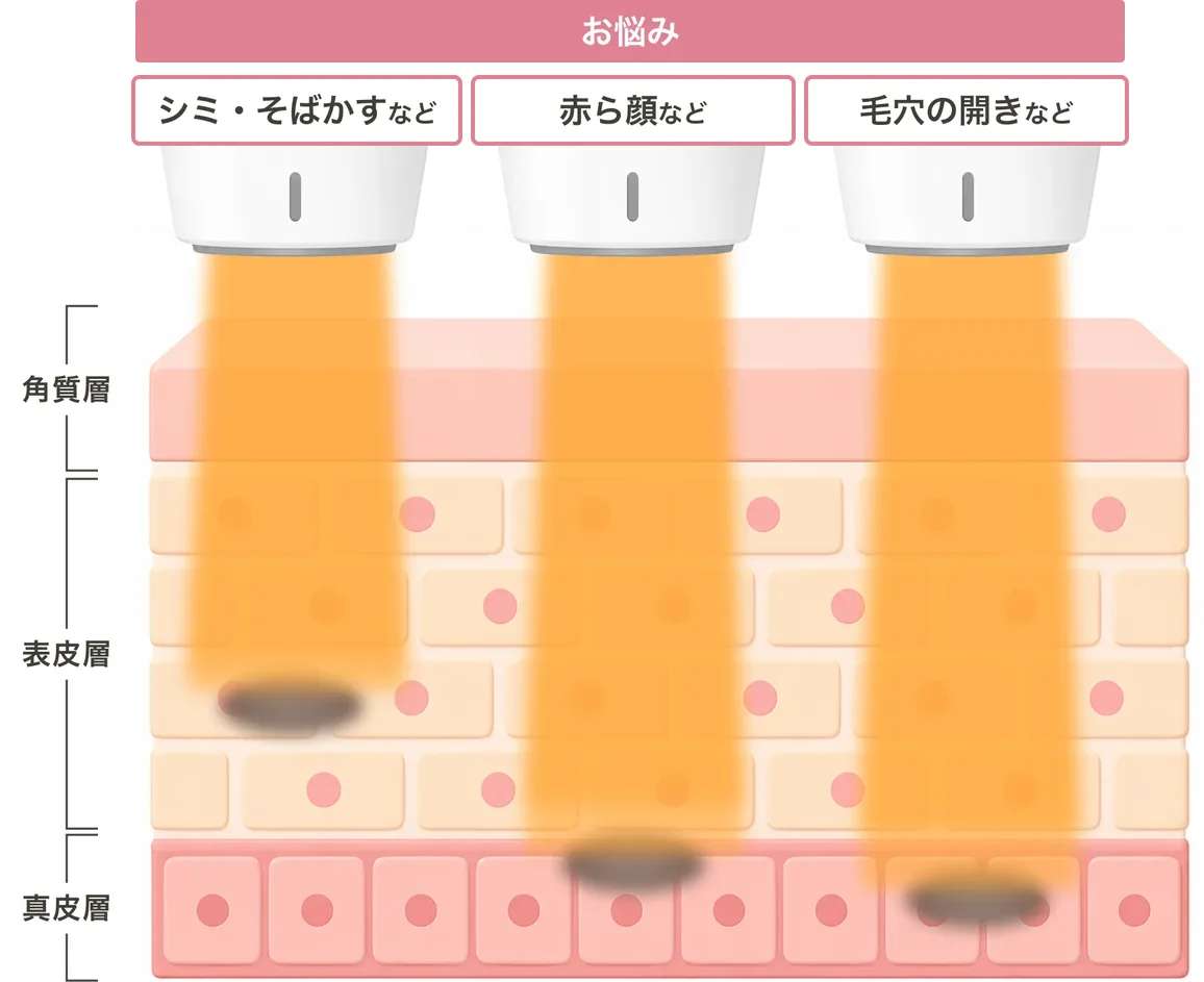 お悩み別（シミ・そばかす／赤ら顔／毛穴の開き）に光が角質層・表皮層・真皮層のどこまで届くかを示した図