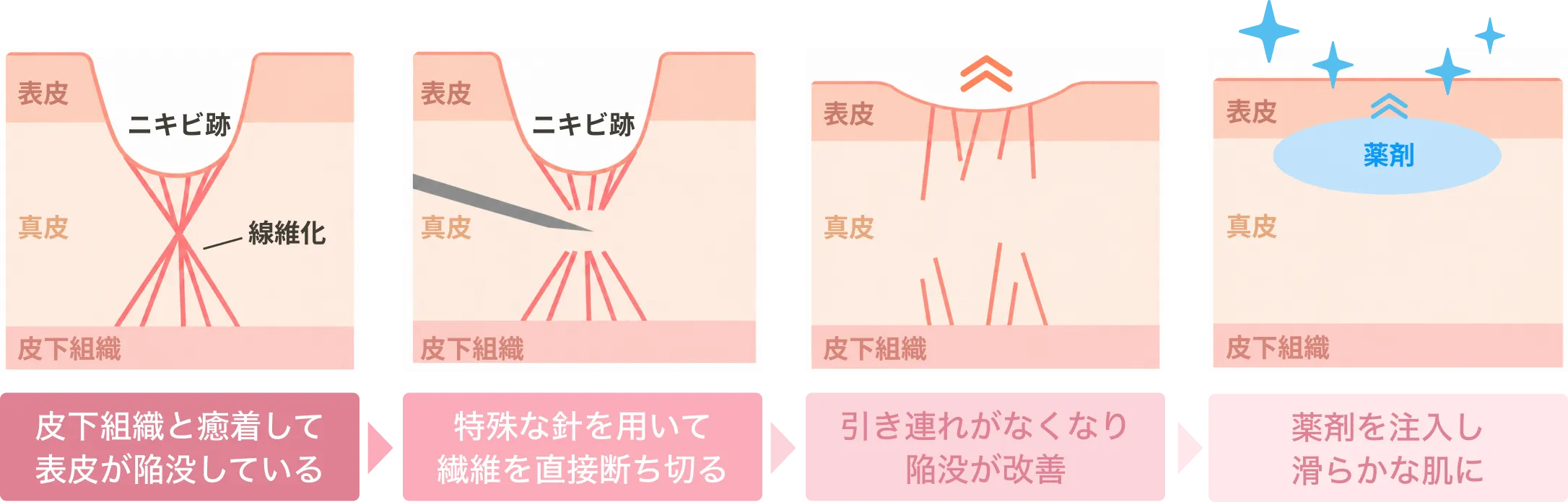 皮下の線維化を針で断ち切り、陥没が改善して薬剤注入で滑らかな肌になるまでの4段階の図