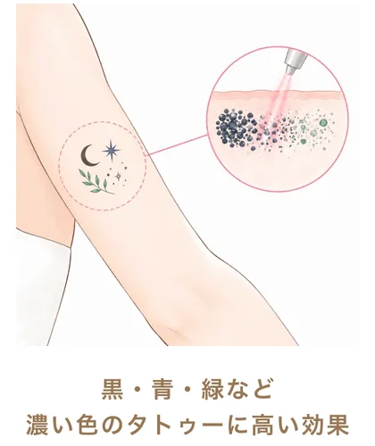 黒・青・緑など濃い色のタトゥーに高い効果