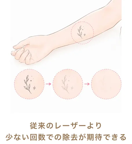 従来のレーザーより少ない回数での除去が期待できる