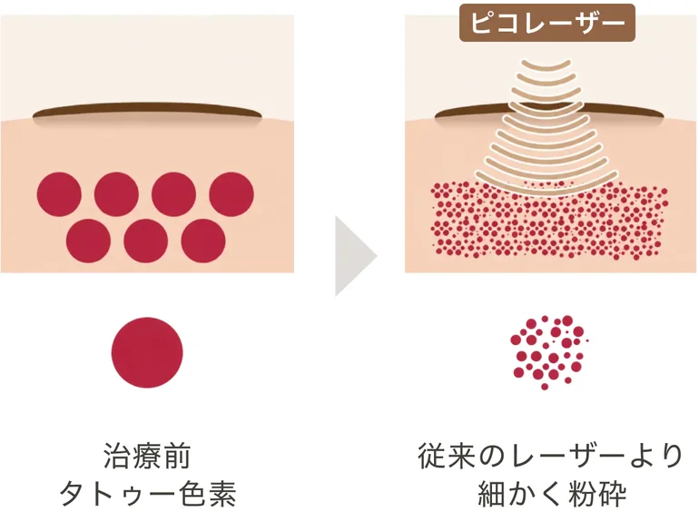 治療前のタトゥー色素と、ピコレーザーで従来のレーザーより細かく粉砕された色素の比較図