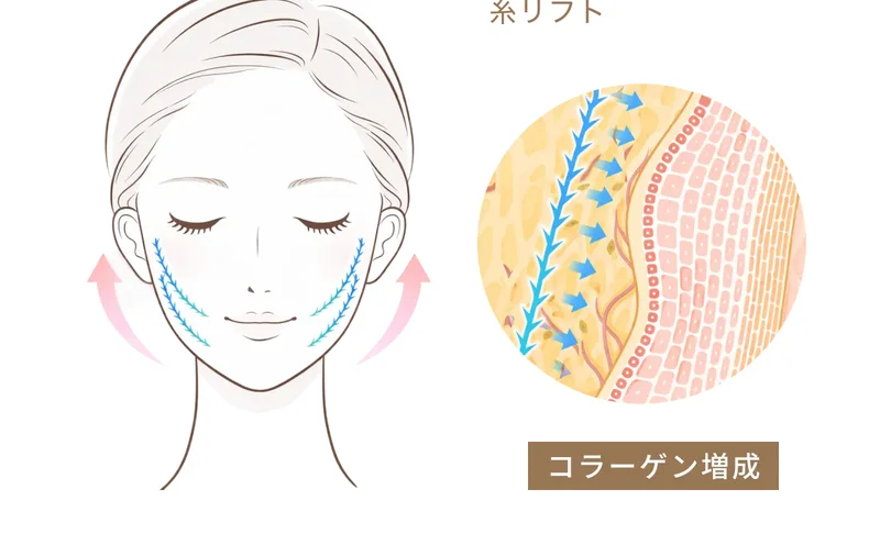 糸リフトで皮下を引き上げ、糸のまわりでコラーゲンが増成される様子を示した図