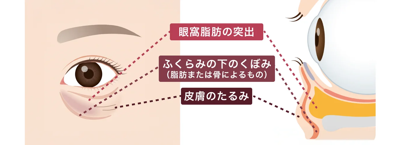 目の下の断面図。眼窩脂肪の突出／ふくらみの下のくぼみ（脂肪または骨によるもの）／皮膚のたるみ の位置を示した図