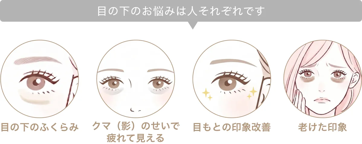 目の下のお悩みは人それぞれです。目の下のふくらみ／クマ（影）のせいで疲れて見える／目もとの印象改善／老けた印象