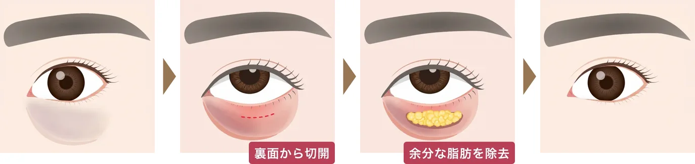 まぶたの裏面から切開し、余分な脂肪を除去するまでの4段階の図