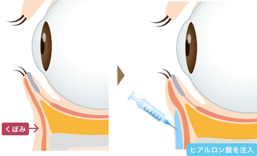 くぼみが残った状態と、ヒアルロン酸を注入して整えた状態の断面図