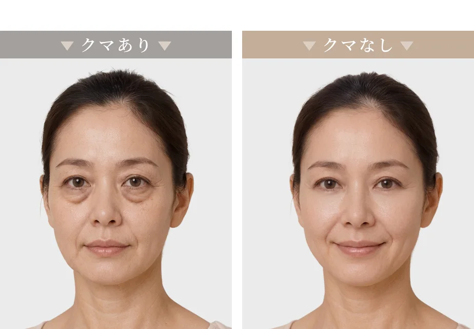 クマありの目もととクマなしの目もとの比較