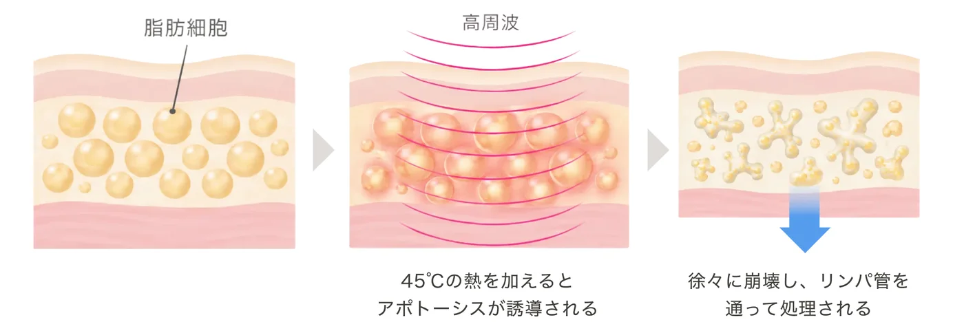高周波による脂肪減少の仕組み。皮下の脂肪細胞に高周波を照射し、45℃の熱を加えるとアポトーシスが誘導され、徐々に崩壊してリンパ管を通って処理されるまでの3段階の図