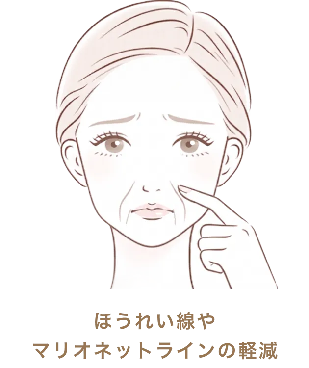 ほうれい線やマリオネットラインの軽減