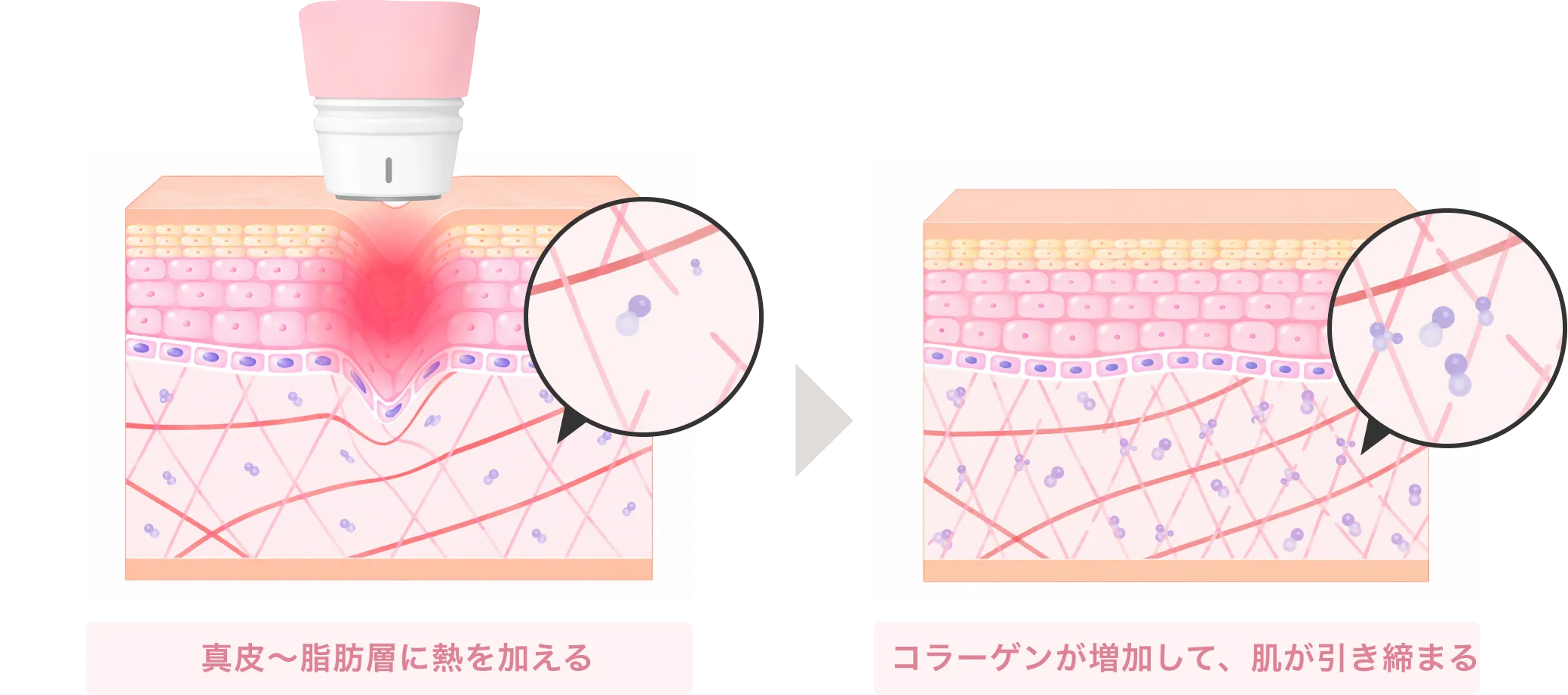 高周波で真皮〜脂肪層に熱を加え、コラーゲンが増加して肌が引き締まるまでの図