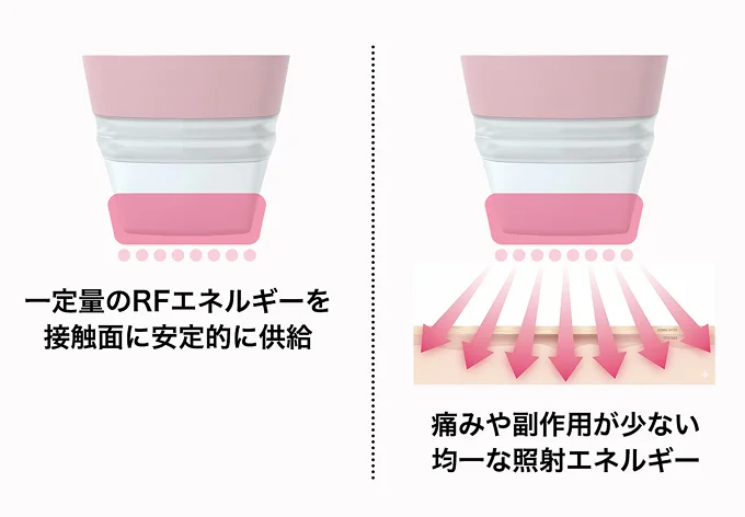 一定量のRFエネルギーを接触面に安定的に供給 痛みや副作用が少ない均一な照射エネルギー