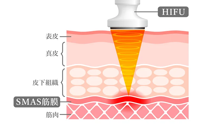 HIFU SMAS筋膜