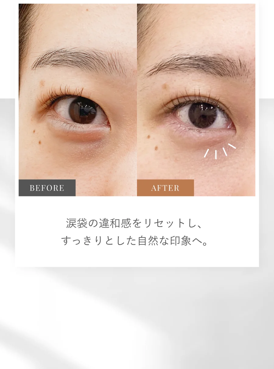BEFORE AFTER 涙袋の違和感をリセットし、すっきりとした自然な印象へ。