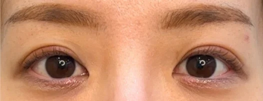 30代女性 埋没法・切らない眼瞼下垂 施術後