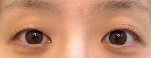 30代女性 埋没法・切らない眼瞼下垂 施術前