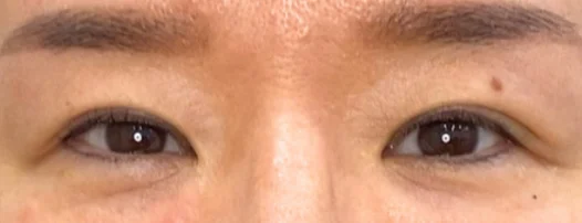 40代女性 埋没法・切らない眼瞼下垂 施術後
